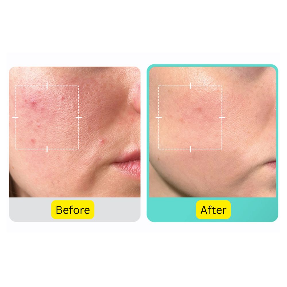 Medicube Azelaic Acid 16% Calming Serum
