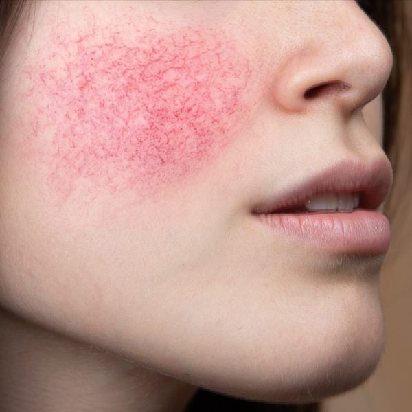Rosacea
